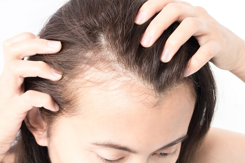 alopecia